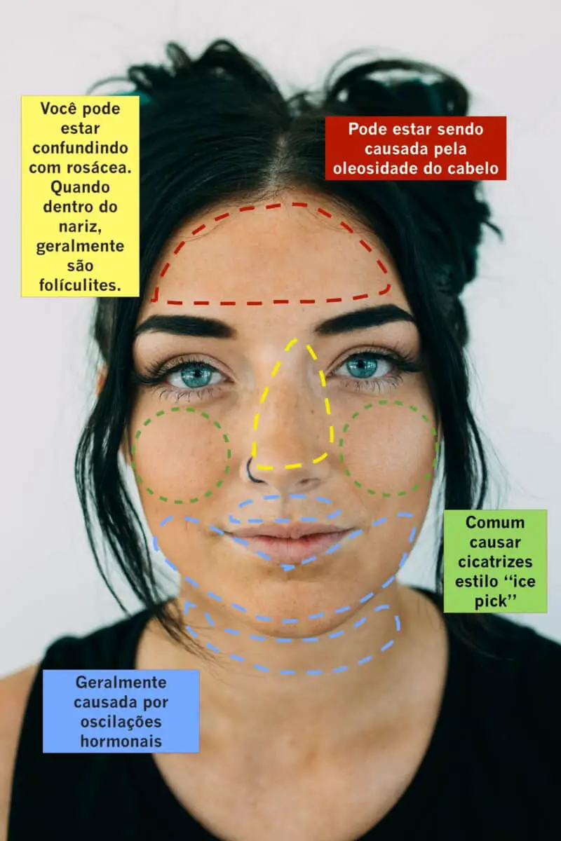 Mapa das Espinhas: O que o Local da Sua Acne Pode Dizer Sobre Ela