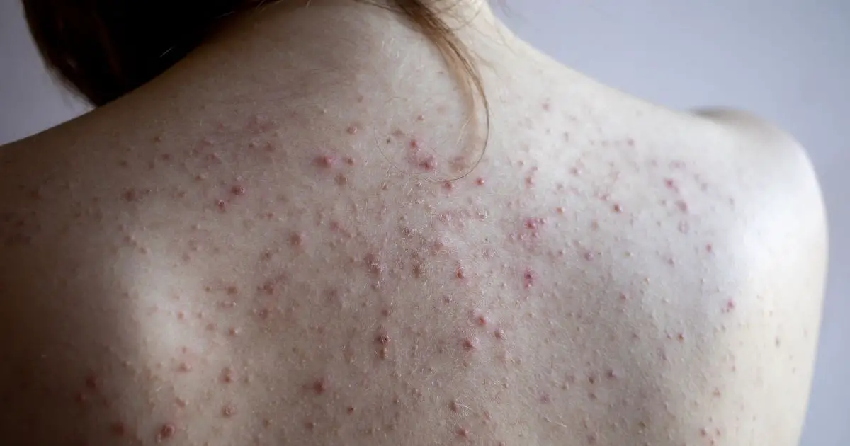 Acne nas Costas: Dermato Responde Tudo o que Você Precisa Saber