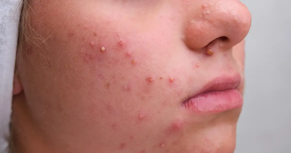 Vitacid para Acne: Antes e Depois