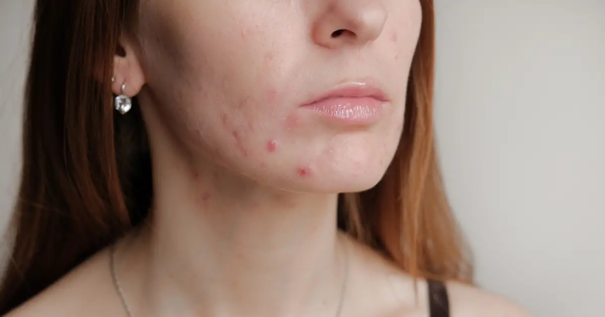Como tratar acne adulta sem Roacutan?